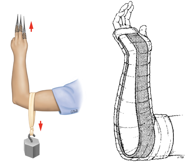 Distal Radius Fractures and Splinting — Kwak Talk